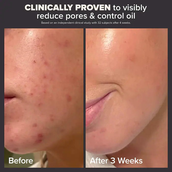 Paula's Choice Skin Perfecting 2% BHA Liquid Exfoliant for Clear Skin