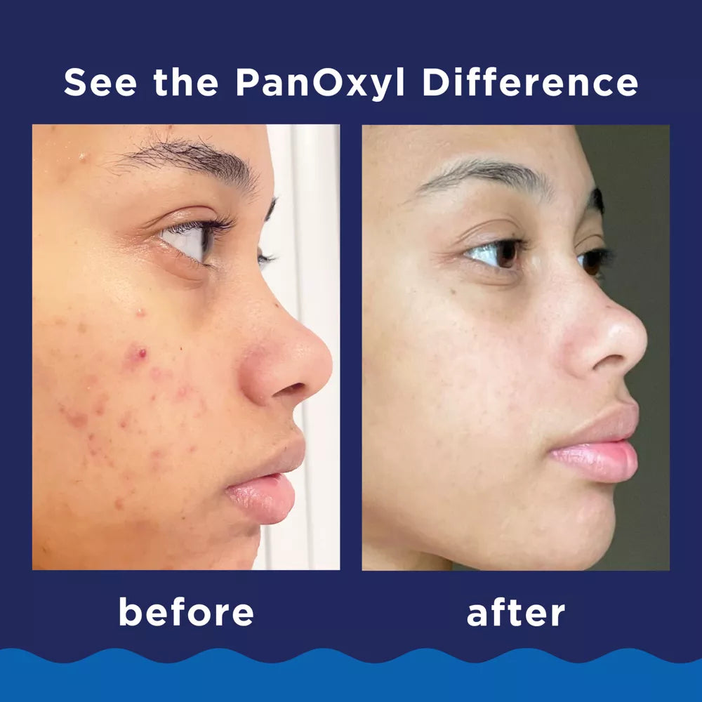 PanOxyl - 10% Benzoyl Peroxide Acne Foaming Wash