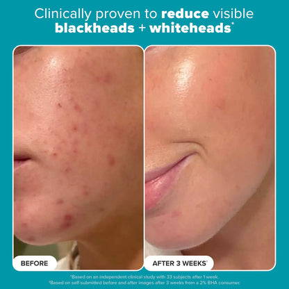 Paula's Choice - Skin Perfecting 2% BHA Exfoliating Toner Pads