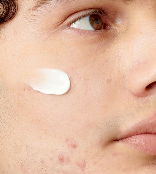 Differin - Adapalene Gel Retinoid