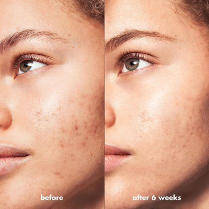 ELF - Blemish Breakthrough Acne Clarifying Cleanser