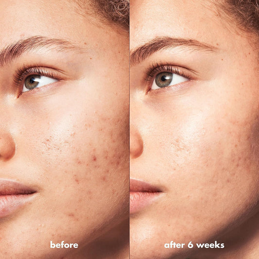 ELF - Blemish Breakthrough Acne Clarifying Cleanser