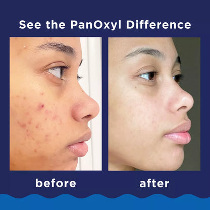 PanOxyl - 10% Benzoyl Peroxide Acne Foaming Wash